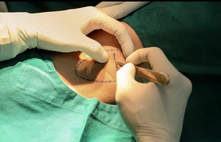 Ứng dụng phẫu thuật cắt tuyến mồ hôi nách hiệu quả tại Khoa Phẫu thuật Tạo hình Thẩm mỹ